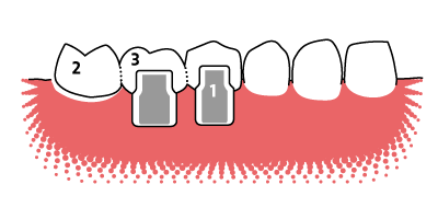 Veranschaulichung der Funktionsweise einer 3-gliedrigen Freiend-Zahnbr&uuml;cke