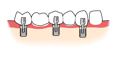 Veranschaulichung der des Aufbaus einer Implantatr&uuml;cke auf zwei Implantaten und einem eigenen Zahn