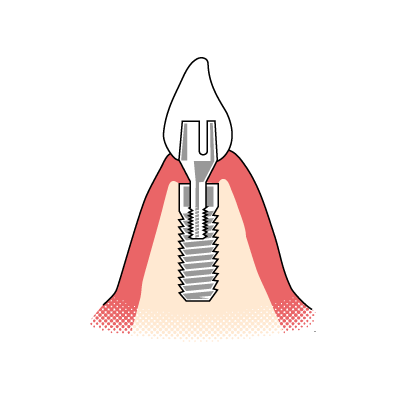 Veranschaulichung des Aufbaus eines Zahnimplantats  und der dazugeh&ouml;rigen Suprakonstruktion